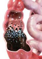 Fecal waste laying in colon